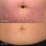 Belly & Body Occlusion Patch™